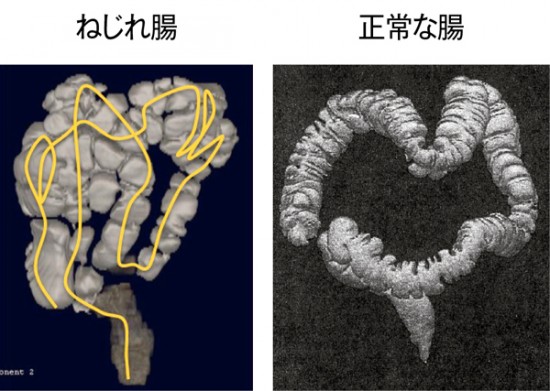 便秘 左脇腹