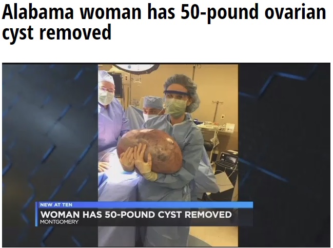 妊娠中 と言われ続けた女性 23キロの卵巣嚢腫を摘出