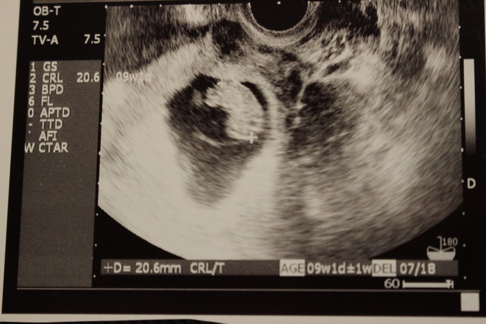 エコー写真で見る 私と赤ちゃんの実録260日