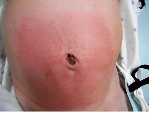 小児科医リレーエッセイ たかが されど でべそ 臍ヘルニアは早期治療できれいに治る たまひよ Online Line News