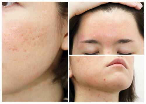 最終レポ タカミクリニック でクレーターと大人ニキビと決別 Preciousnews Line News