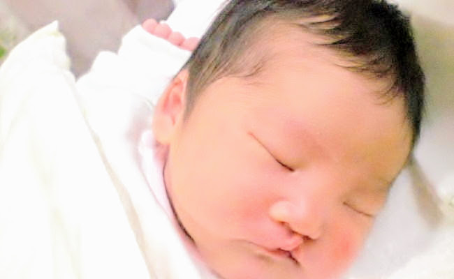 生まれてから口唇口蓋裂と判明 妊娠中から手術を受けるまで 体験談 生まれてから口唇口蓋裂と判明 妊娠中から手術を受けるまで 体験談