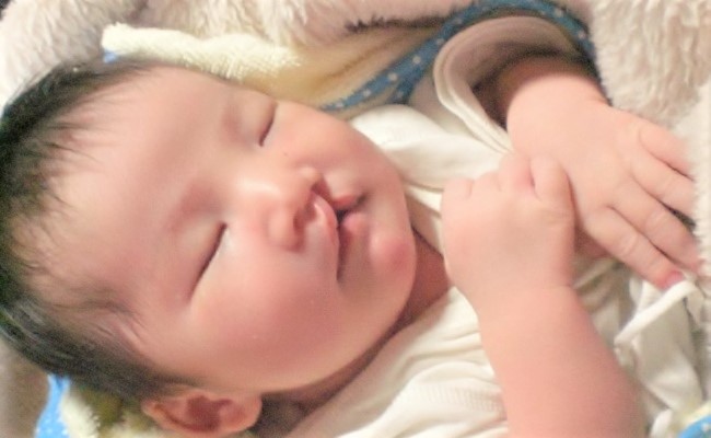 口唇口蓋裂って 先天異常を持った娘の症状と治療 前編