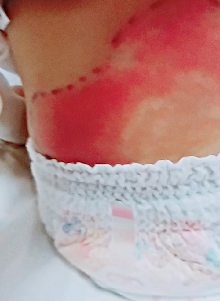 蜂窩織炎で赤ちゃんが入院 ただのおむつかぶれと思ったら 体験談 ベビーカレンダー Line News